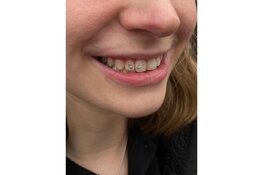 Nieuw bij Kingdom Tattoo & Piercing Alkmaar: Toothgems